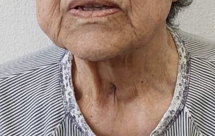 Σύγκλειση της τραχειοστομίας σε ασθενή με Χρόνια Αποφρακτική Πνευμονοπάθεια  στη ΜΦΗ Καλλιστώ